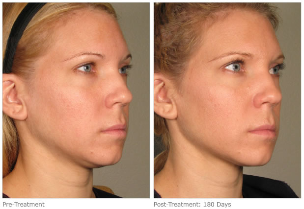 VENUS LEGACY before-after-full-face-6